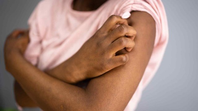How Should You Treat Seborrheic Dermatitis How Should You Treat Seborrheic Dermatitis